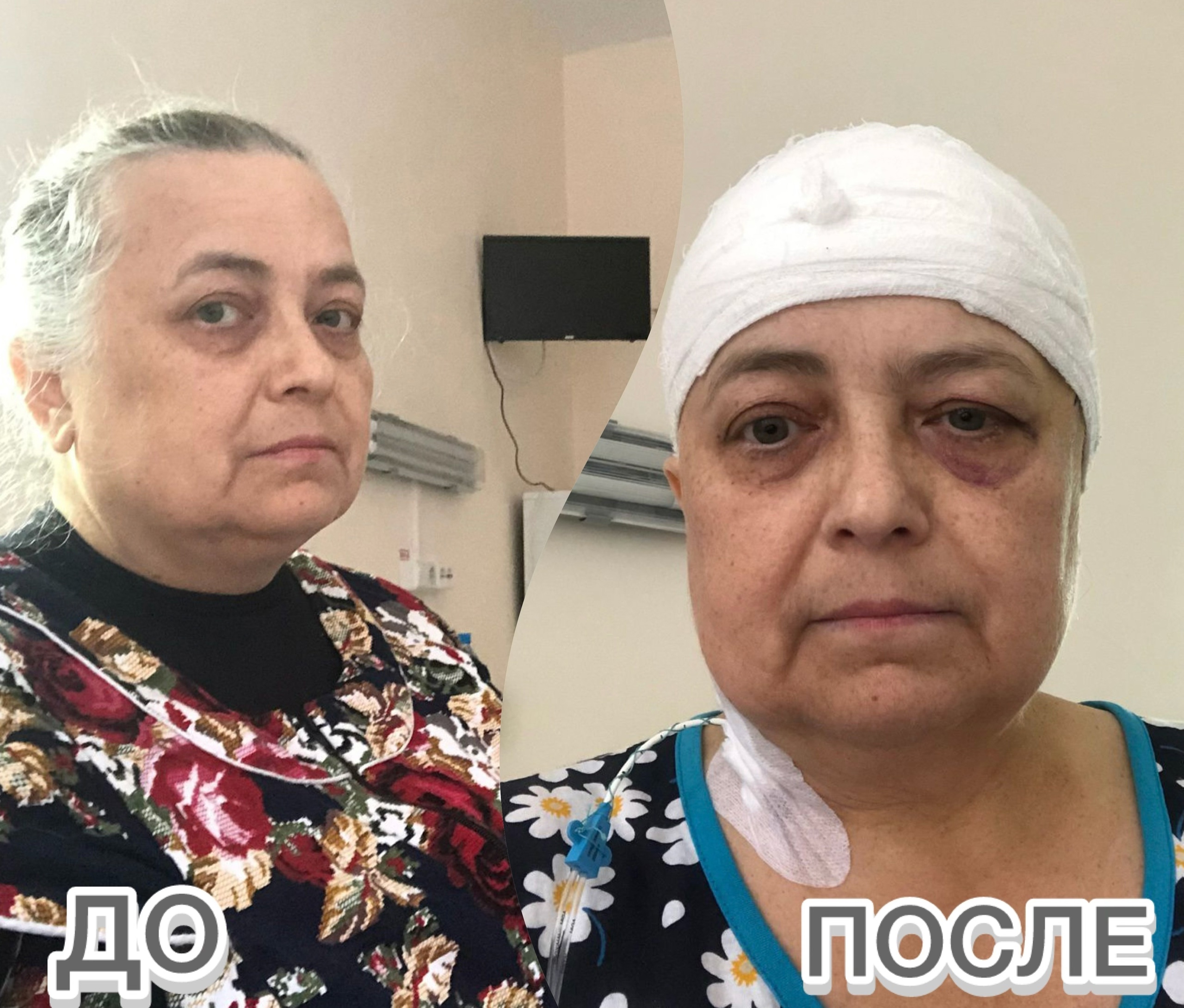 Пациентка, перенесшая операцию на мозге, поделилась своими впечатлениями от работы врачей ЯОКБ